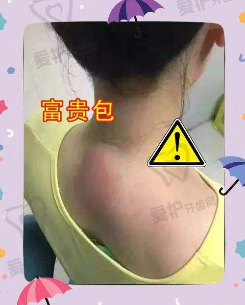 深圳今喜土麦森吸脂去富贵包的原理是什么?