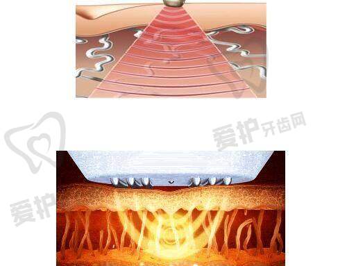 如何减轻水光针停用后的肌肤变化?