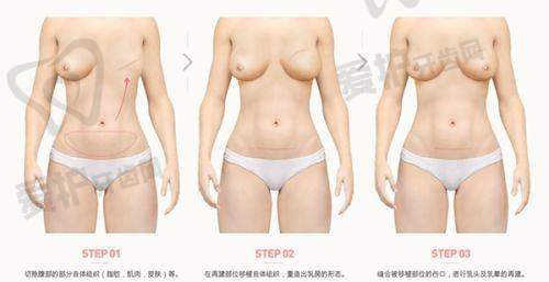 选择天津美莱董岩岩医生进行曼托水滴假体隆胸有哪些保护?