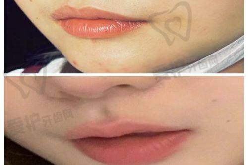 朱迪医生双眼皮真实实例