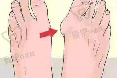 曼托水滴假体隆胸的安心性如何?