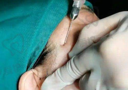 曼托水滴假体隆胸术后需要注意什么?