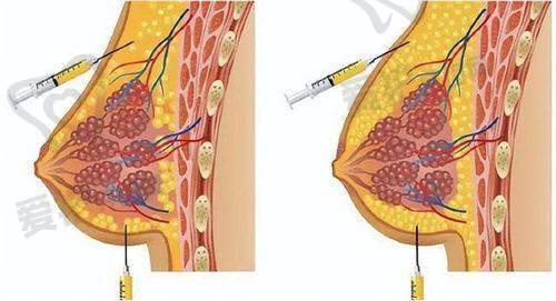 天津美莱董岩岩曼托水滴假体隆胸值得选择吗?