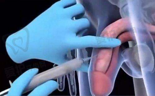 水光针停用后肌肤会有哪些变化?