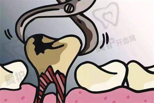 拔牙后止血与伤口保护要注意什么?