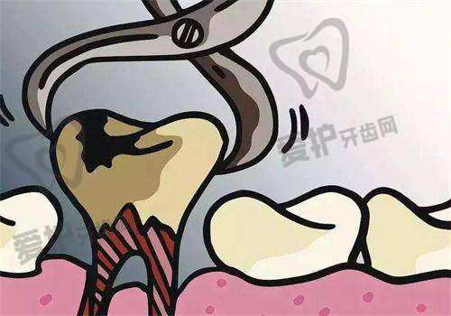 中山贝壳口腔医院拔牙99元起，专业服务让您告别拔牙困扰轻松无忧 