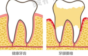 陆冠充金属托槽矫正适合哪些人群?