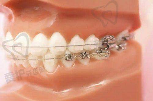 韩国奥齿泰种植牙价格为何如此吸引人?