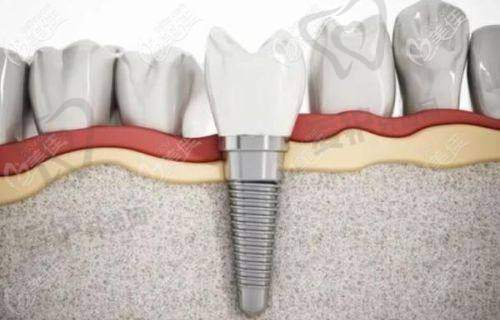 哪些因素会影响拔牙后种植牙的时间?