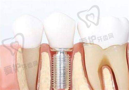 如何判断自己拔牙后是否可以种植牙了?