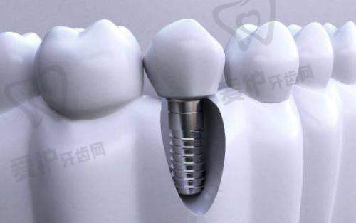 徐州夏禾口腔医院做韩国奥齿泰种植牙3580元起，性价比超高超划算！ 