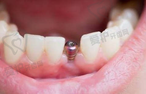 登腾种植牙的成效如何确保?