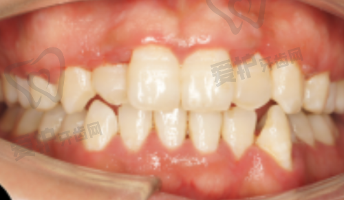 5、榆林德系口腔兰春祥医生患者评价