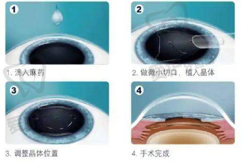 上饶爱尔眼科医院和铁路医院的收费标准哪个更合理?