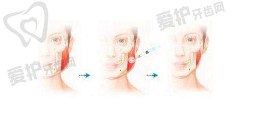 胸部异物取出后需要注意什么?