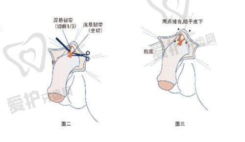 美波婷胶原丰胸的注意事项