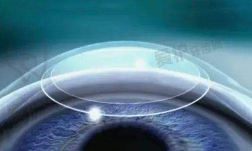 患者实例:见证ICL晶体植入的神奇成效