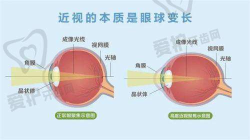 重庆开展蔡司smile3.0全飞秒手术的优质医院