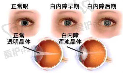 外伤会引发白内障吗?