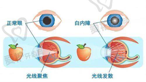 中毒会导致白内障形成吗?