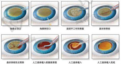 遗传因素会诱发白内障吗?