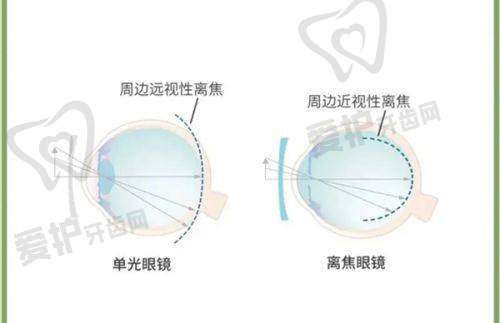 选择蔡司smile3.0全飞秒手术的建议与提醒