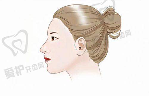 患者选择广州荔医余东文胸部异物取出的原因有哪些?