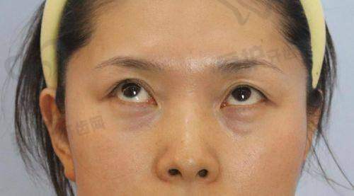 重庆军美医院在光能祛眼袋方面还有哪些保护?