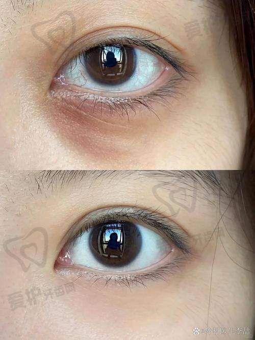 胡金香医生在光能祛眼袋领域有何优势?