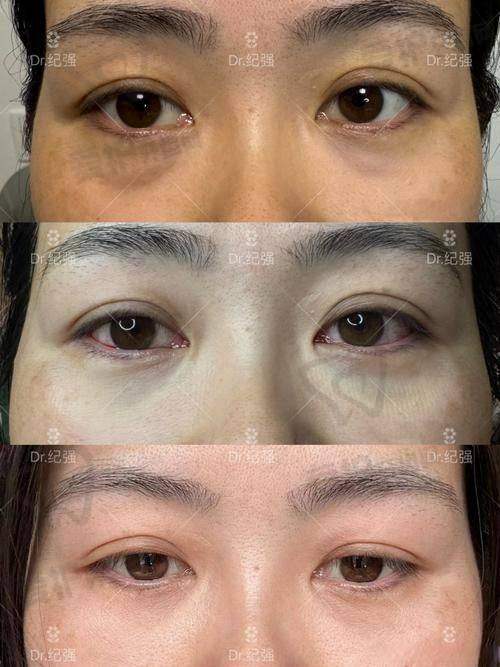 什么是光能祛眼袋?