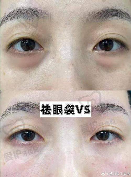 与其他祛眼袋方法相比,光能祛眼袋有哪些独特之处?