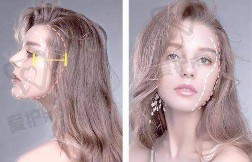 杭州浮想国蒋铮铮医生整形技术怎么样?