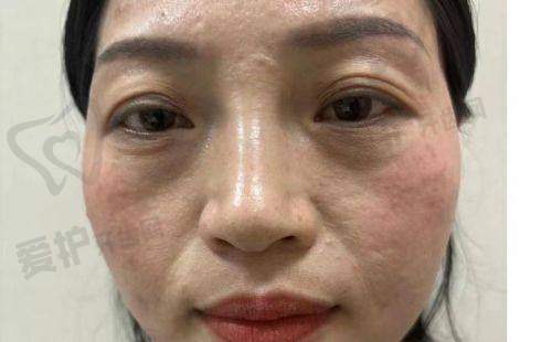 认识ellanse少女针和玻尿酸