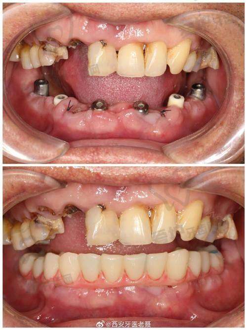 深圳爱康美口腔:攻克疑难种牙问题