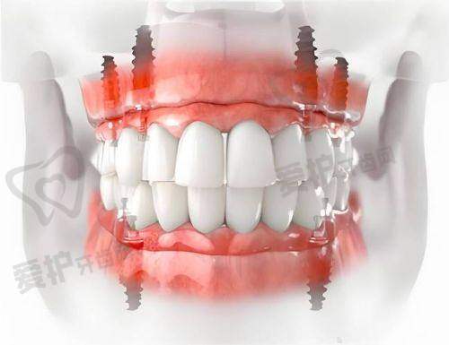 深圳新安麦芽口腔:连锁品牌的种牙实力