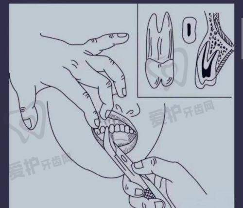 拔牙创口愈合情况对种植牙时间有什么影响?