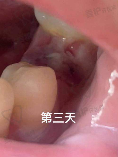 拔牙后如何识别异常情况?