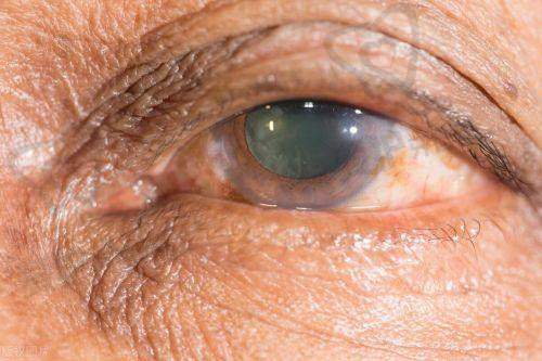 辐射会促使白内障出现吗?