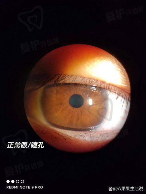 免疫与代谢异常和白内障有关系吗?