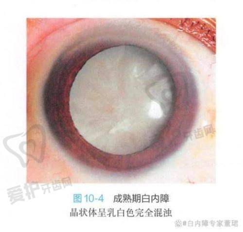 其他因素会诱发白内障吗?