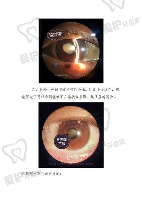 如何判断自己是否因为看手机过度而增加了患白内障的风险呢?