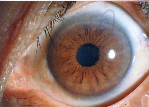 手机发出的蓝光会导致白内障吗?