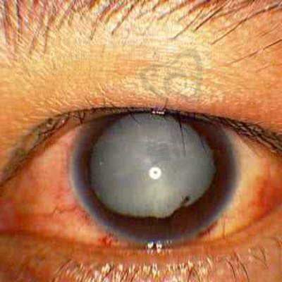 过度用眼和白内障有什么关系呢?