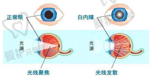 怎样减少看手机对眼睛的伤害,降低患白内障的风险呢?