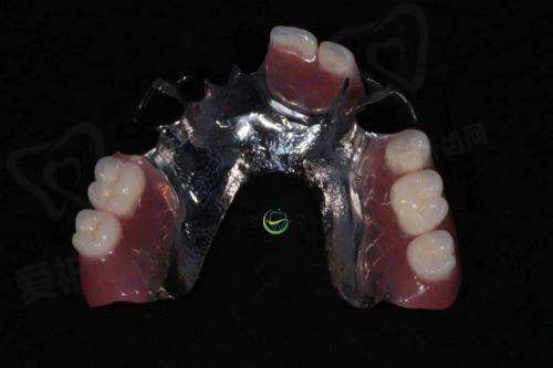 全口假牙的材质有哪些,不同材质价格差异如何?