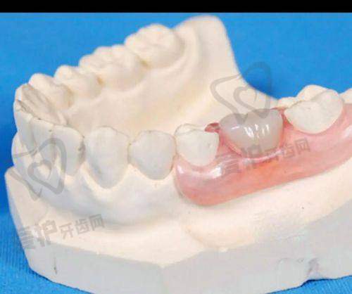 佩戴全口假牙后有哪些注意事项?